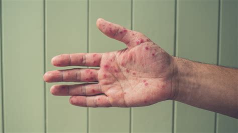 Hand Foot Mouth Rash Causes - Infoupdate.org