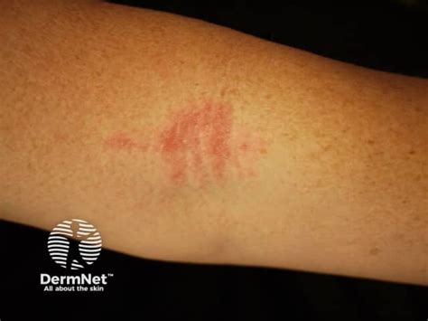Atopic flexural eczema images