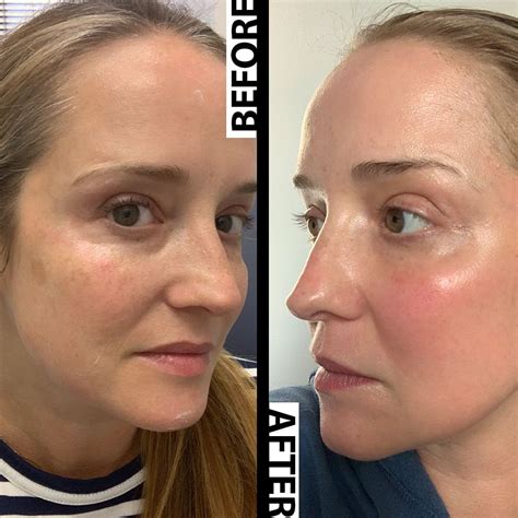 levisa lazer: Before & After Photos That Will Amaze You - 7akctzt