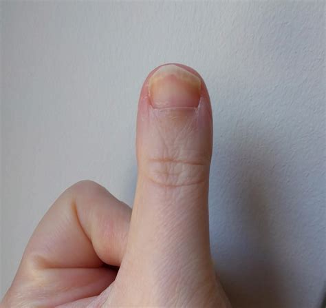 What's wrong with my nail? No trauma but it's always growing wonky