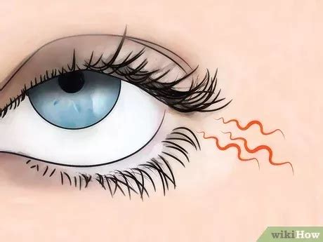 How to know if you have eye mites symptoms treatments – Artofit