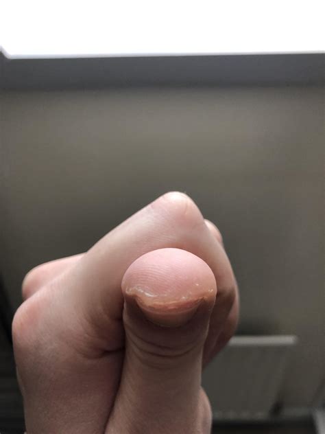 How to remove the hardened dead skin around my fingers and prevention