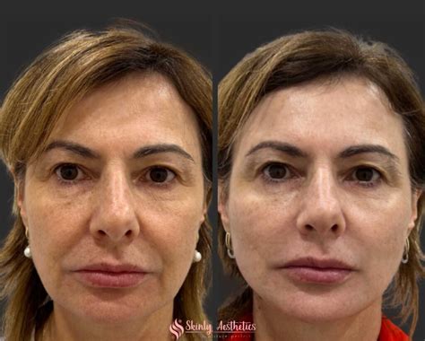 Non-Surgical PDO thread lift - Benefits, Costs, Results & Procedure Steps