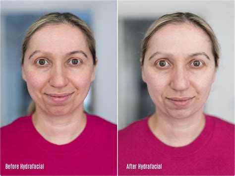 hydrafacial treatment  fitzgerald private clinic