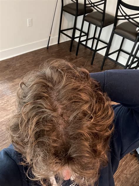 Crown loss : r/Hairloss