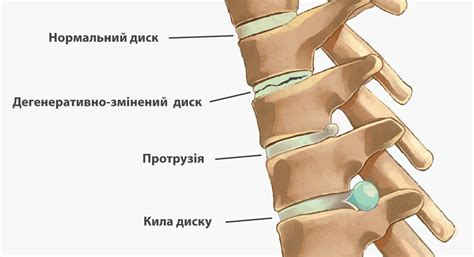 Протрузія та кила диску поперекового відділу хребта - Метод Козявкіна