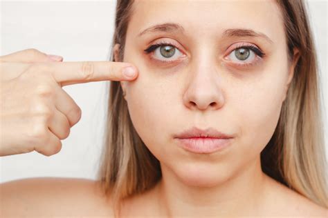 How to Reduce Dark Circles & Puffy Eyes Without Surgery - Corona Clinic