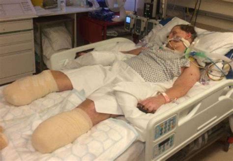 Maidstone teacher's legs and fingers amputated after sepsis battle