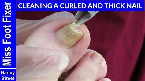 how to fix curved toenails at home