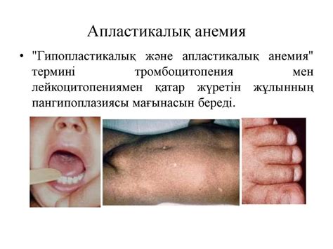 Анемия. Анемия түрлері - презентация онлайн