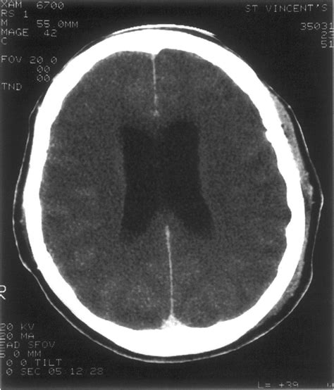 Case 1. Acute postoperative obstructive hydrocephalus with ventricular ...