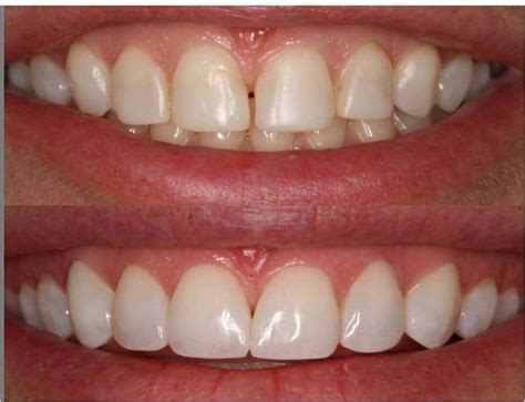 Teeth Veneers Before And After