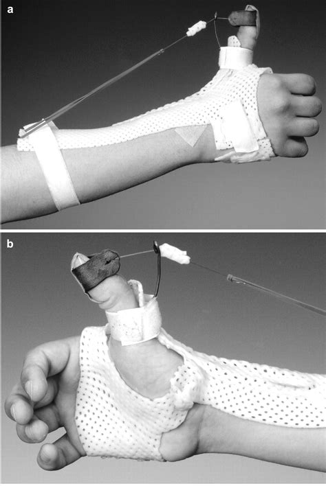 evaluation  early dynamic splinting  static splinting