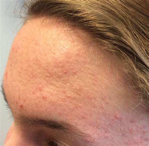 Perforating Folliculitis Face