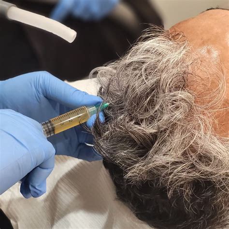 PRP Hair Restoration