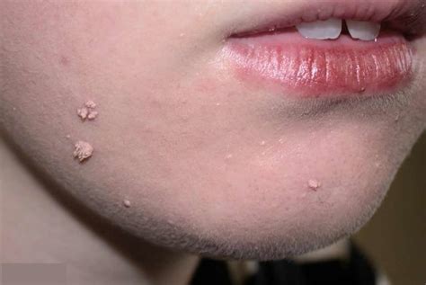 warts plantar wart wart  finger hands face wart treatment