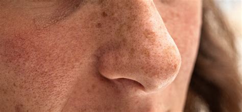 sun damage treatments columbus  nina deep md