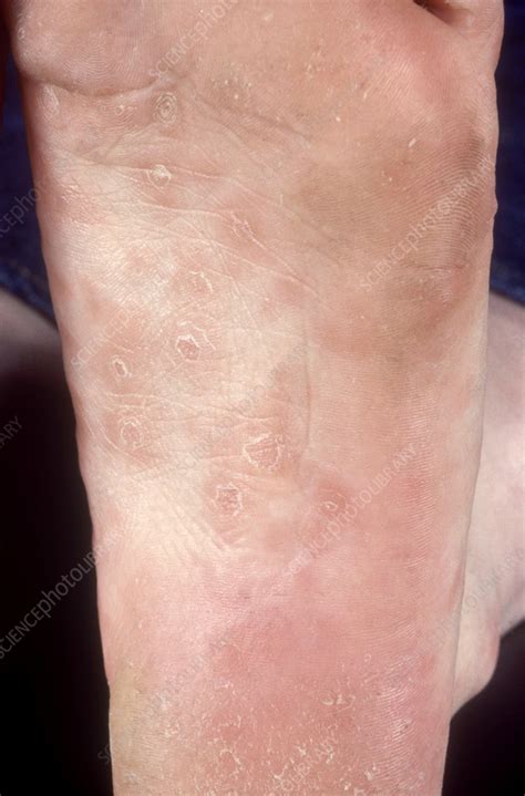 Syphilis Face Rash