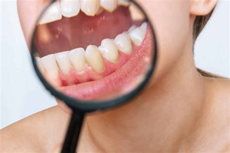 How to Prevent Plaque Buildup - Mountain Aire Dentistry in Broomfield