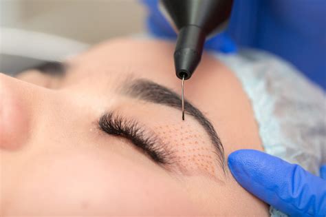 Non-Surgical Eyelid Lift - Skin Muse MD