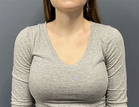 female shoulder reduction 6 weeks postop front 2 Dr Barry Eppley