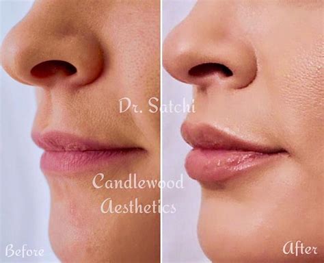 Lip Enhancement | Med Spa located in Danbury, CT | Candlewood ...