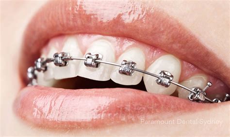 metal braces coloured braces paramount dental sydney paramount