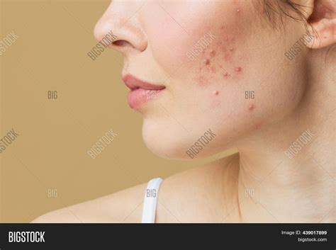 young woman bad skin image photo  trial bigstock