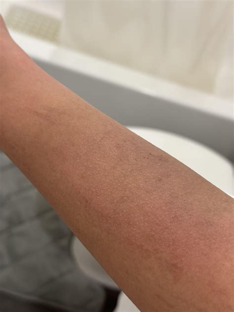 I'm 30 and have this rash on my hand. It's itchy, and most