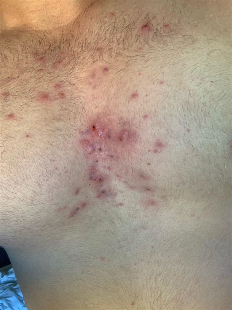 I got my hormone levels tested, got 1320 ng/dl testosterone in blood