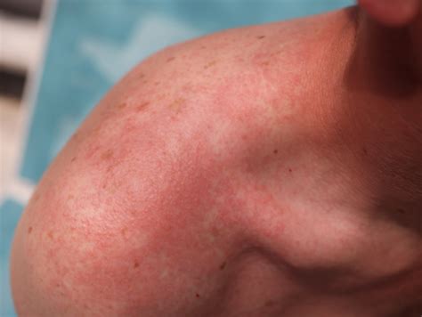 urticaria skin health institute