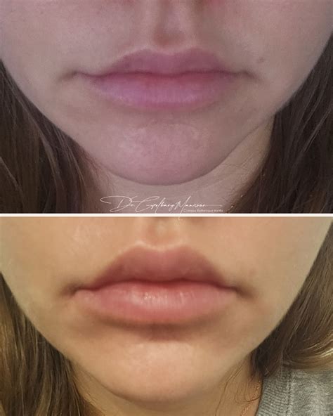 botox lip flip  montreal clinique esthetique homa
