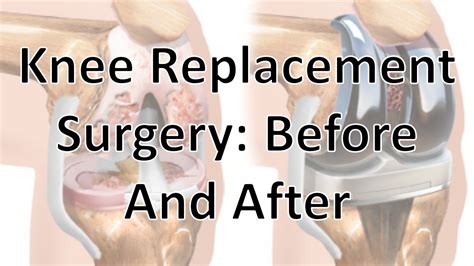 Knee Replacement Surgery Before And After - YouTube