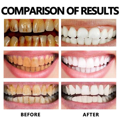 Gum Regrowth Foam, Gum Treatment Foam, Anti-Inflammatory, Gum Tissue