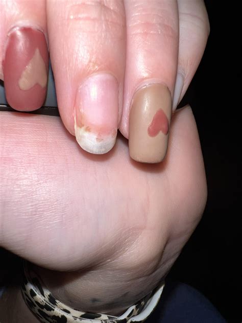 nail fungus? : r/NailFungus
