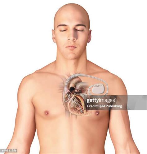 artificial pacemaker stock  high res pictures  images