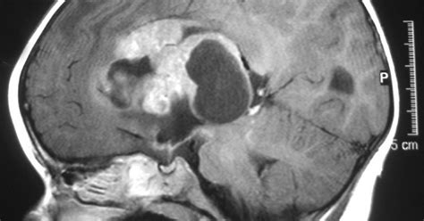 Tumor cerebral: tipos, clasificación y síntomas