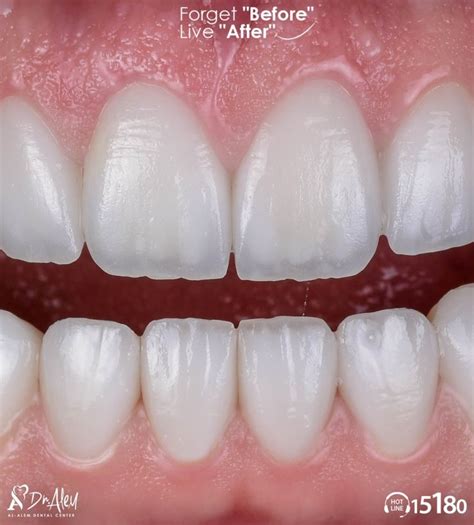 Dental Veneers Services | DR.Al-alem