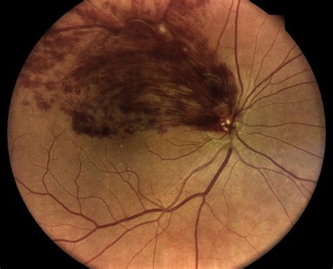 Retinal Vein Occlusion Orlando | Retina Consultants of Orlando