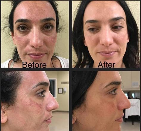 Microneedling before and after – JJ ELLIE SKINCARE