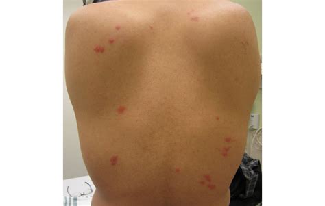 Types of bug bites in bed - cardioserg