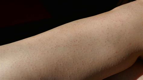 Itching After Laser Hair Removal? Get Relief Fast! – Dermeleve®