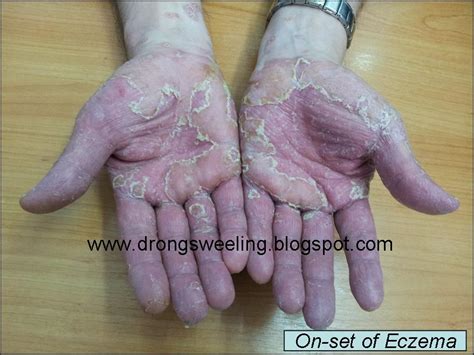 TCM News: TCM Physician Treat Eczema on Sole and Palm Dry and Cracked