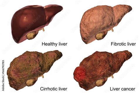 liver disease progression  hepatitis    viral infection