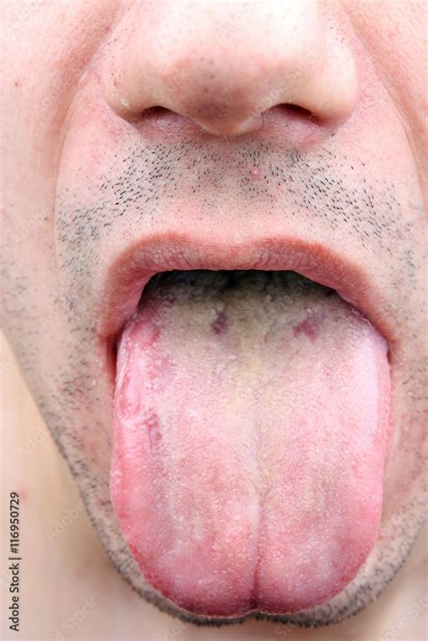 Bacterial infection disease tongue Stock Photo | Adobe Stock