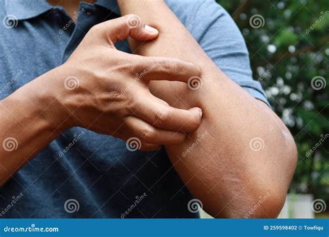 man suffering  itching skin close  stock photo image  rash