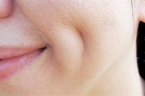 All About Cheek Dimples: How they're formed - Allure Plastic Surgery
