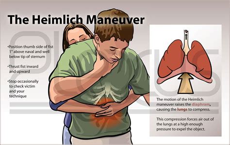 Heimlich Maneuver - Plexus Medical Art, LLC | Heimlich maneuver, Heimlich, Health and safety poster