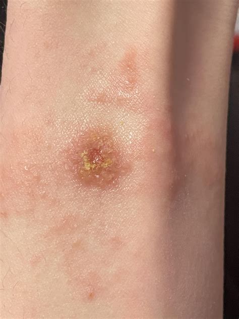 How should I care for my infected wound? : r/woundcare