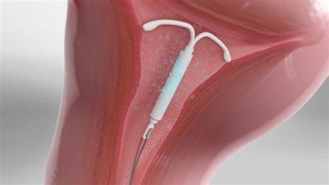 Mirena Iud In Cervix